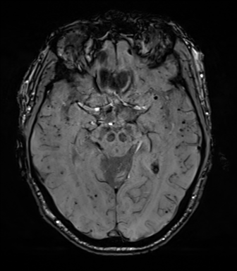 File:Cerebral amyloid angiopathy (Radiopaedia 46082-50433 Axial SWI 35).png