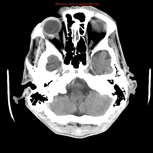 File:Cerebral and orbital tuberculomas (Radiopaedia 13308-13310 B 7).jpg