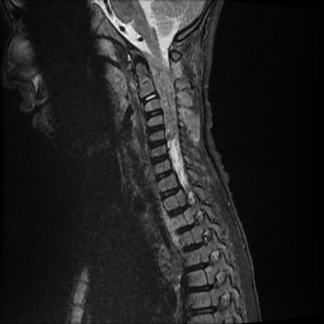 File:Cerebral and spinal tuberculosis (Radiopaedia 90489-107838 Sagittal STIR 8).jpg