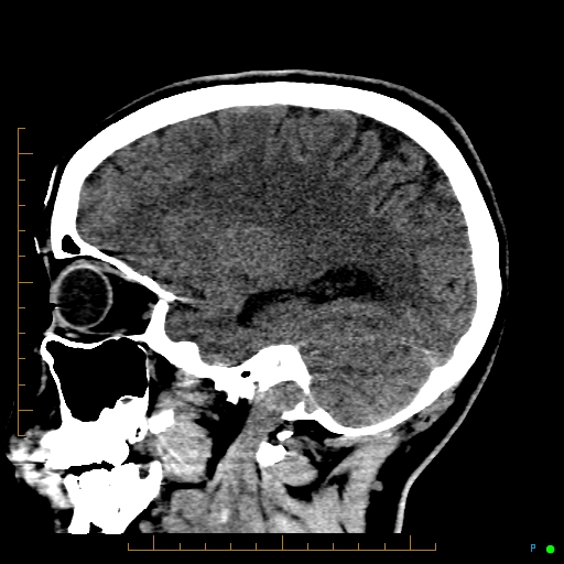 Cerebral arteriovenous malformation (AVM) (Radiopaedia 78162-90706 A 54).jpg