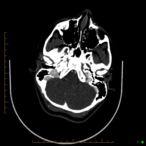 Cerebral arteriovenous malformation (AVM) (Radiopaedia 78162-90706 Axial CTA 68).jpg