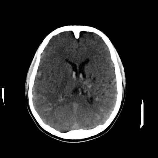 Cerebral arteriovenous malformation (Radiopaedia 28518-28759 Axial non-contrast 41).jpg