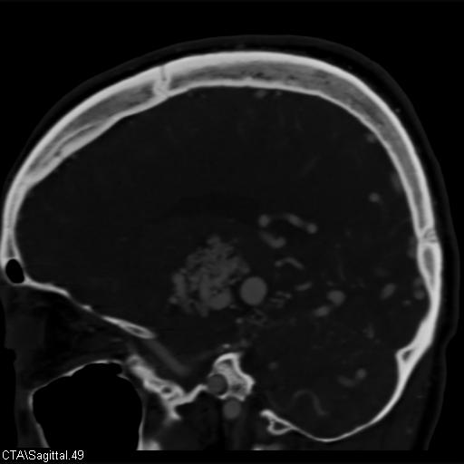 File:Cerebral arteriovenous malformation (Radiopaedia 28518-28759 D 46).jpg