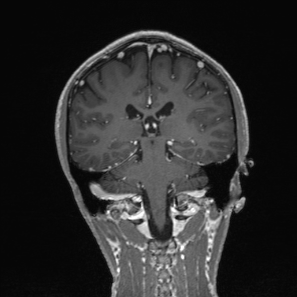 Cerebral arteriovenous malformation (Radiopaedia 30198-30813 F 37).jpg