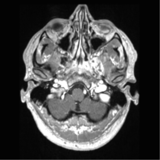File:Cerebral arteriovenous malformation (Radiopaedia 39259-41506 AX T1 MPR C+ 9).png