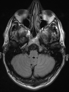 File:Cerebral arteriovenous malformation (Radiopaedia 55798-62372 Axial FLAIR 4).png