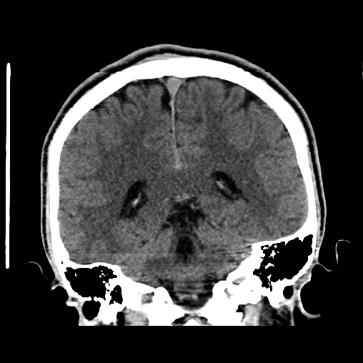Cerebral arteriovenous malformation (Radiopaedia 61964-70028 Coronal non-contrast 40).jpg