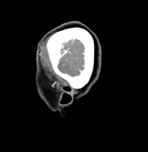 Cerebral arteriovenous malformation (Radiopaedia 73830-84645 D 6).jpg