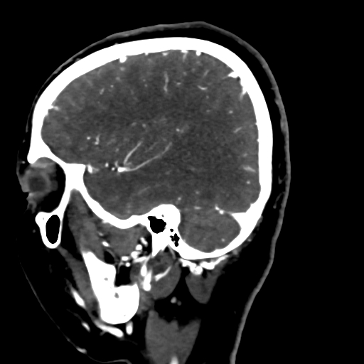 File:Cerebral arteriovenous malformation (Radiopaedia 73830-84645 Sagittal C+ delayed 22).jpg