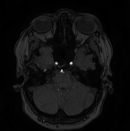 Cerebral arteriovenous malformation (Radiopaedia 74411-85654 Axial MRA 17).jpg