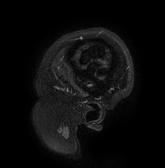 Cerebral arteriovenous malformation (Radiopaedia 74411-85654 Sagittal FLAIR 3).jpg