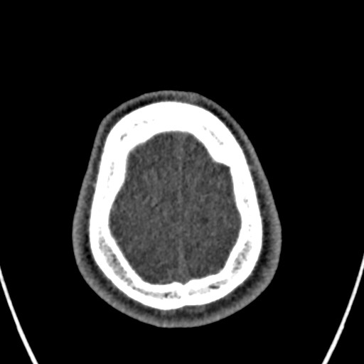 Cerebral arteriovenous malformation (Radiopaedia 78188-90746 Axial non-contrast 162).jpg