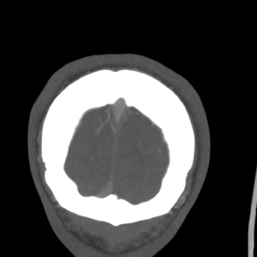 Cerebral arteriovenous malformation (Spetzler-Martin grade 2) (Radiopaedia 41262-44076 F 62).png