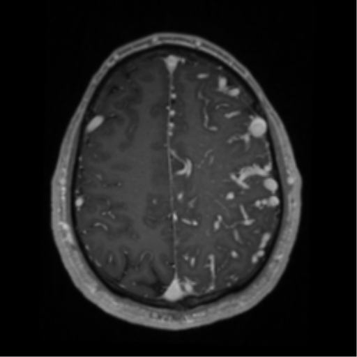 Cerebral arteriovenous malformation - huge (Radiopaedia 35734-37272 Axial T1 C+ 56).png