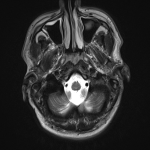 File:Cerebral arteriovenous malformation - huge (Radiopaedia 35734-37272 Axial T2 2).png
