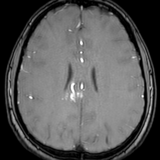 Cerebral arteriovenous malformation at posterior body of corpus callosum (Radiopaedia 74111-84925 Axial MRA 144).jpg