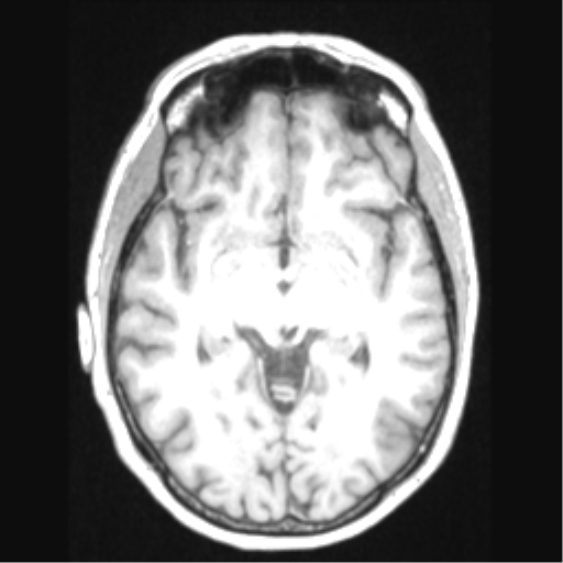 Cerebral arteriovenous malformation with hemorrhage (Radiopaedia 34422-35737 Axial T1 35).png