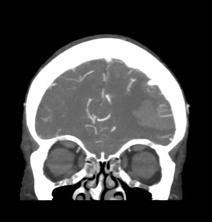 Cerebral arteriovenous malformation with lobar hemorrhage (Radiopaedia 44725-48511 B 13).png