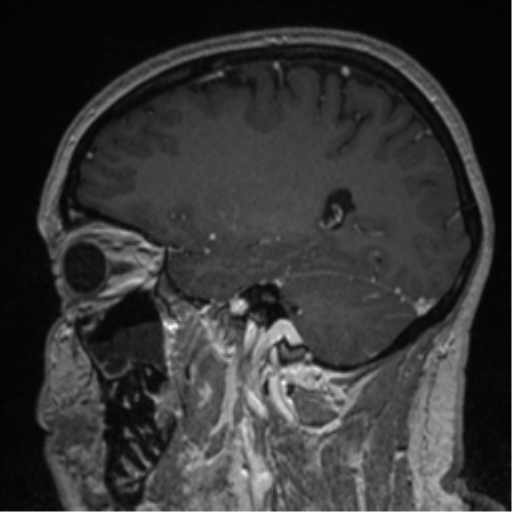 Cerebral cavernoma and development venous anomaly (Radiopaedia 37603-39482 Sagittal T1 C+ 64).png