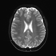 Cerebral cavernous venous malformation (Radiopaedia 70008-80021 Axial DWI 20).jpg