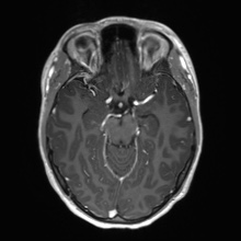 Cerebral cavernous venous malformation (Radiopaedia 70008-80021 Axial T1 C+ 27).jpg