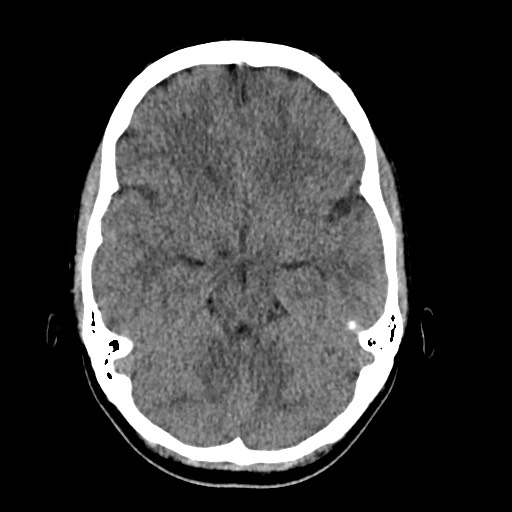 Cerebral cavernous venous malformation (Radiopaedia 70008-80022 Axial non-contrast 17).jpg