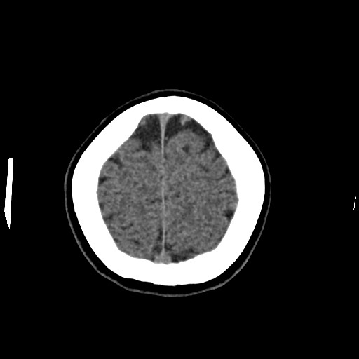 Cerebral cavernous venous malformation (Radiopaedia 70008-80022 Axial non-contrast 48).jpg
