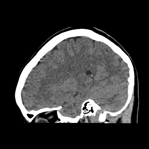 File:Cerebral cavernous venous malformation (Radiopaedia 70008-80022 C 19).jpg