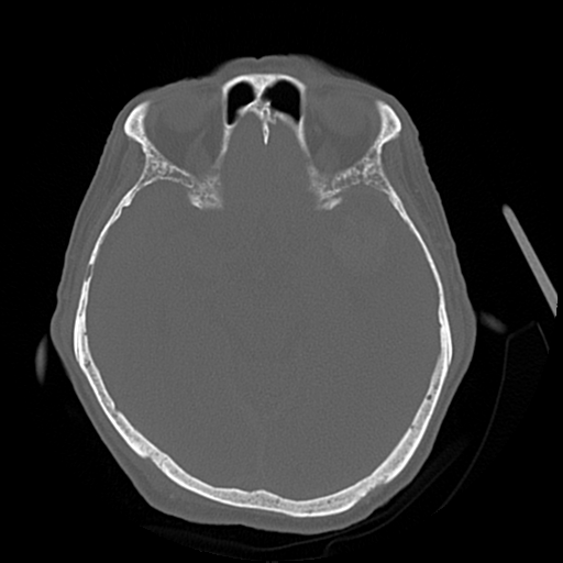 Cerebral contusions, subarachnoid hemorrhage and subdural hygromas (Radiopaedia 55399-61827 Axial bone window 22).png