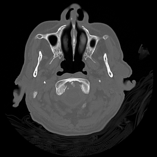 Cerebral contusions, subarachnoid hemorrhage and subdural hygromas (Radiopaedia 55399-61827 Axial bone window 4).png
