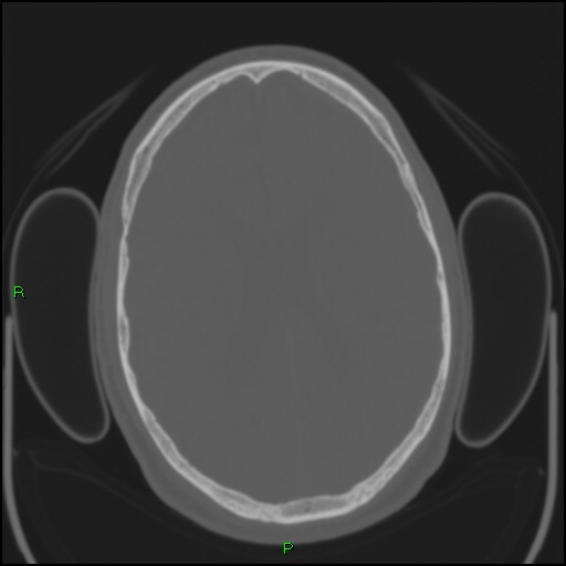 File:Cerebral contusions (Radiopaedia 33868-35039 Axial bone window 132).jpg