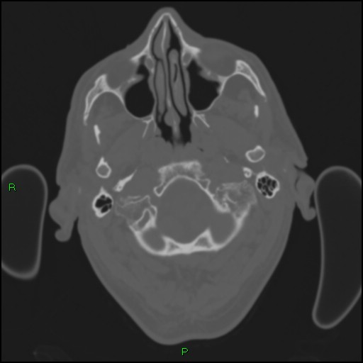 Cerebral contusions (Radiopaedia 33868-35039 Axial bone window 16).jpg