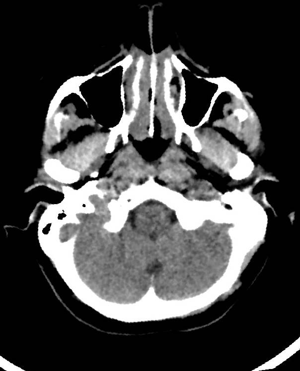 Cerebral edema due to severe hyponatremia (Radiopaedia 89826-106938 Axial non-contrast 18).jpg
