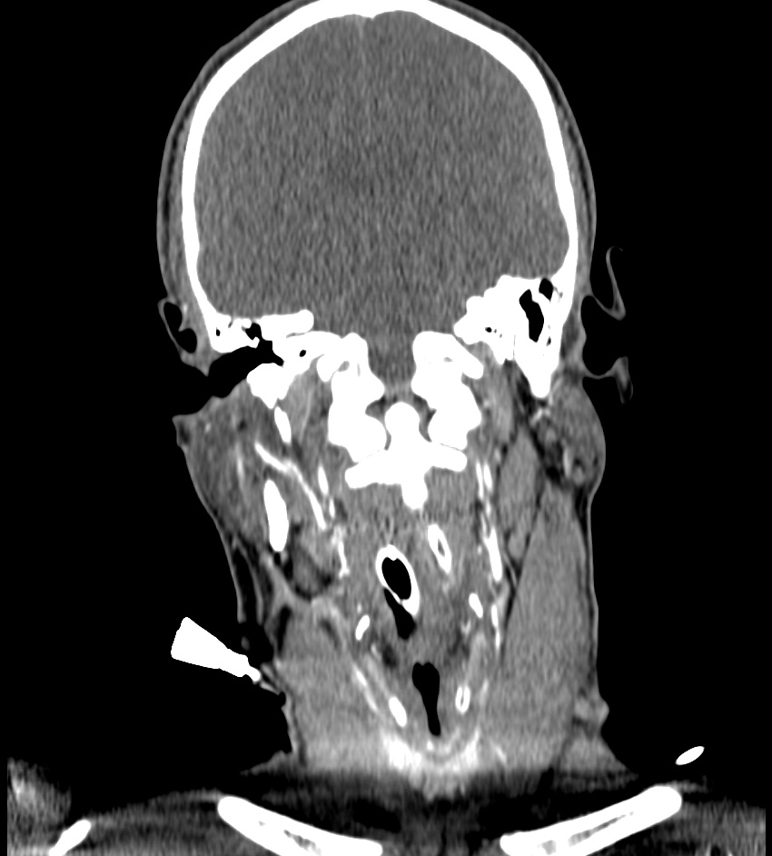 Cerebral edema in an overdose patient (Radiopaedia 72005-82539 B 71).jpg