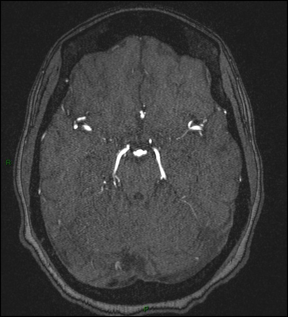Cerebral fat embolism (Radiopaedia 35022-36525 Axial TOF 76).jpg