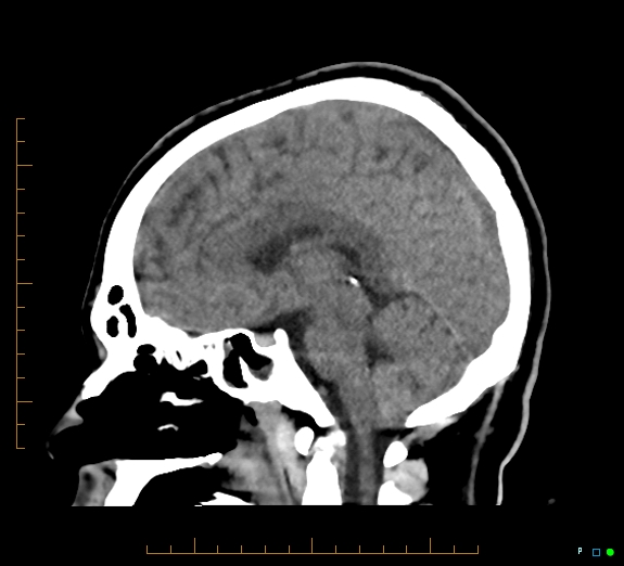 Cerebral fat embolism (Radiopaedia 85521-101220 B 27).jpg
