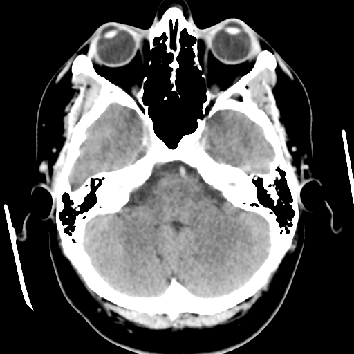 Cerebral hemorrhage secondary to arteriovenous malformation (Radiopaedia 33497-34561 B 14).png