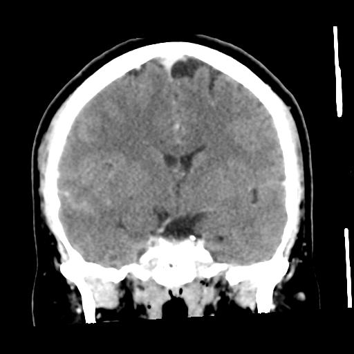 File:Cerebral hemorrhage secondary to arteriovenous malformation (Radiopaedia 33497-34561 C 31).png