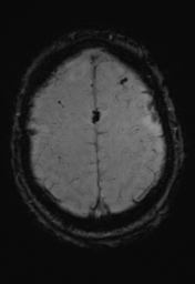 File:Cerebral hemorrhagic contusions- temporal evolution (Radiopaedia 40224-42757 D 32).png