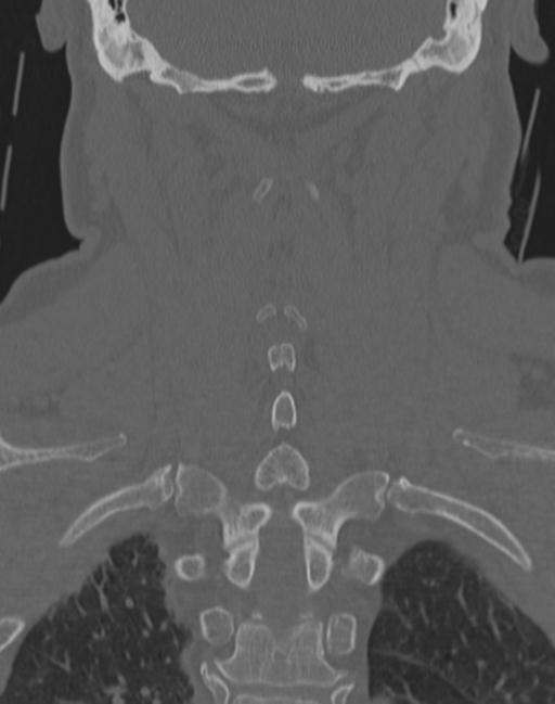 Cerebral hemorrhagic contusions and cervical spine fractures (Radiopaedia 32865-33841 Coronal bone window 54).jpg
