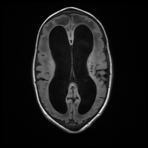 File:Cerebral manifestations of mucopolysaccharidosis type I (Radiopaedia 59171-66487 C 12).jpg