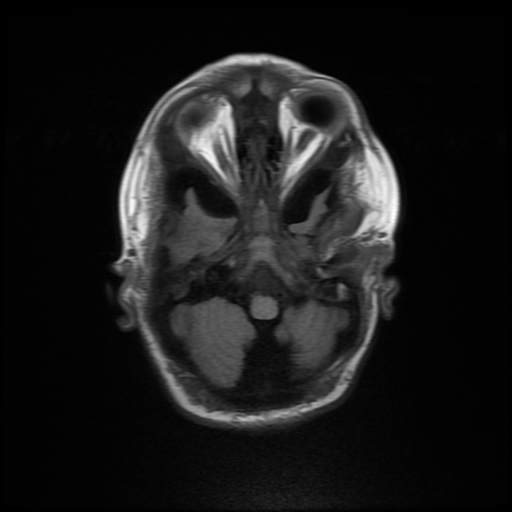 File:Cerebral manifestations of mucopolysaccharidosis type I (Radiopaedia 59171-66487 C 3).jpg