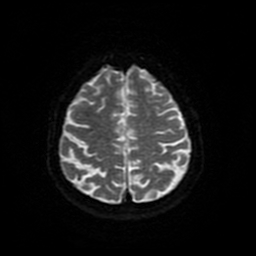 Cerebral metastases - melanoma (Radiopaedia 80972-94522 Axial DWI 87).jpg