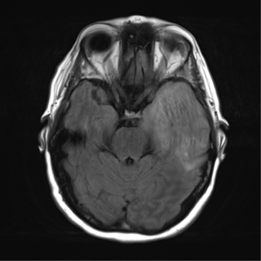 File:Cerebral metastasis mimicking glioblastoma (Radiopaedia 69155-78937 Axial FLAIR 12).png
