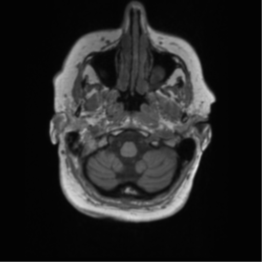 Cerebral metastasis mimicking glioblastoma (Radiopaedia 69155-78937 Axial T1 2).png