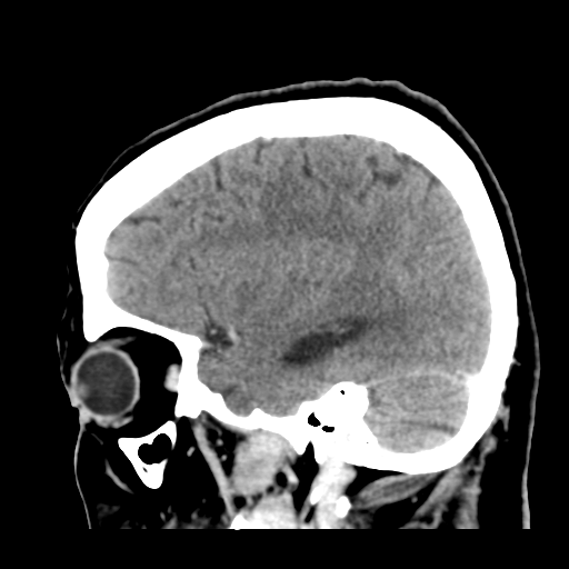 File:Cerebral metastasis to basal ganglia (Radiopaedia 81568-95412 Sagittal C+ delayed 42).png