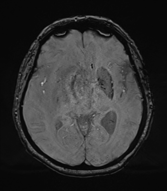 Cerebral metastasis to basal ganglia (Radiopaedia 81568-95413 Axial SWI 40).png