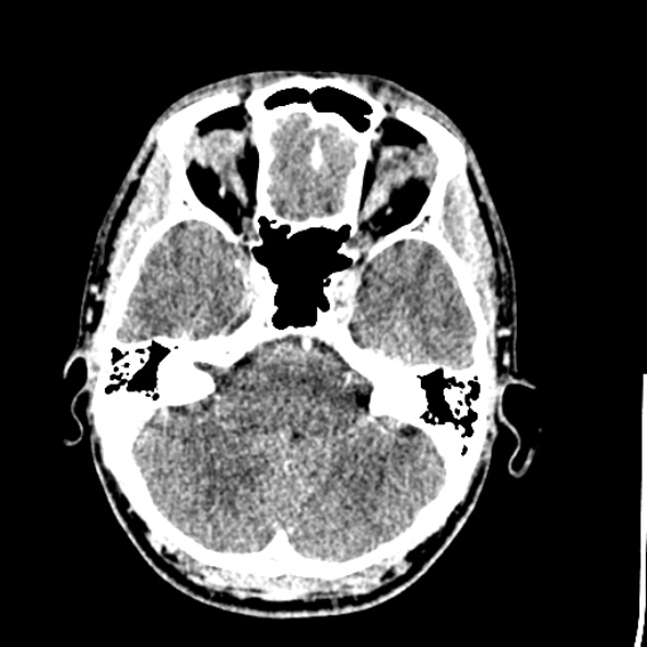 Cerebral toxoplasmosis (Radiopaedia 53993-60131 Axial C+ delayed 19).jpg
