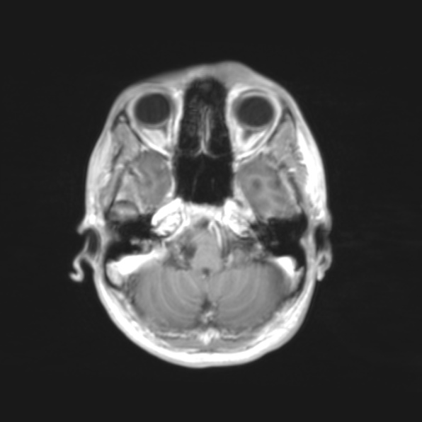 File:Cerebral toxoplasmosis (Radiopaedia 53993-61435 Axial T1 3).jpg