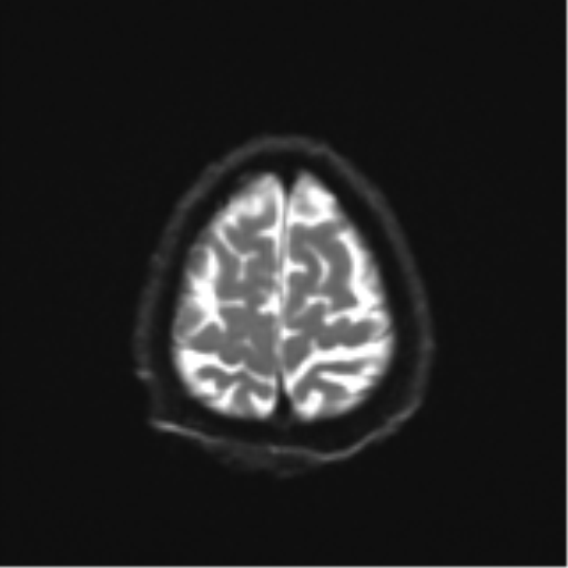 Cerebral toxoplasmosis (Radiopaedia 54575-60804 Axial DWI 28).png